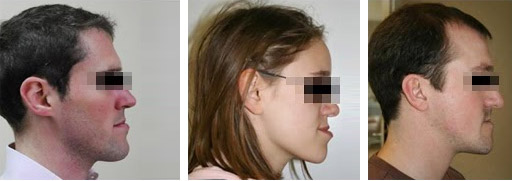 Menton En Avant Genioplastie Chirurgien Maxillo-Facial Paris