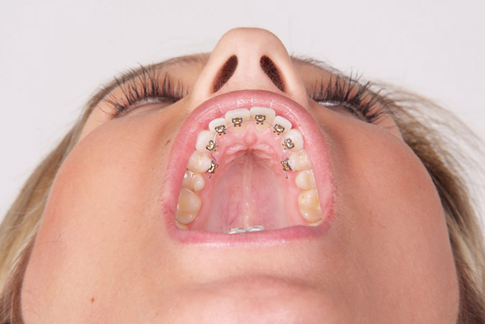 Orthodontie Et Chirurgie Maxillo Faciale Bagues Linguales