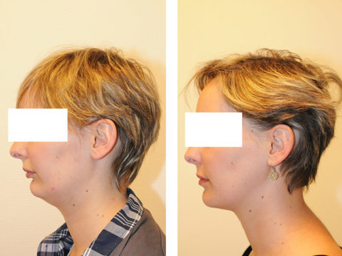 Chirurgie des Mâchoires Paris, Chirurgie Orthognatique Paris