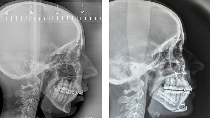 Classe Ii Squelettique Traitée Par Ostéotomie Bi Maxillaire Avec Impaction Maxillaire