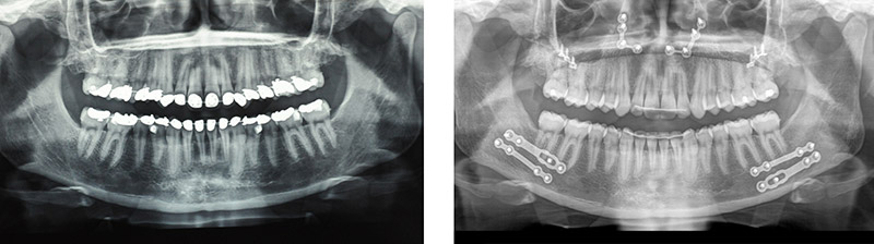 Classe Ii Squelettique Traitée Par Ostéotomie Bi Maxillaire D’avancée 2