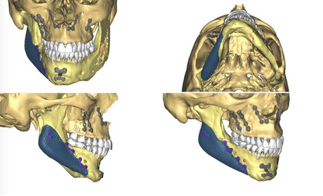 implants mandibulaires 2 chirurgien maxillo facial paris