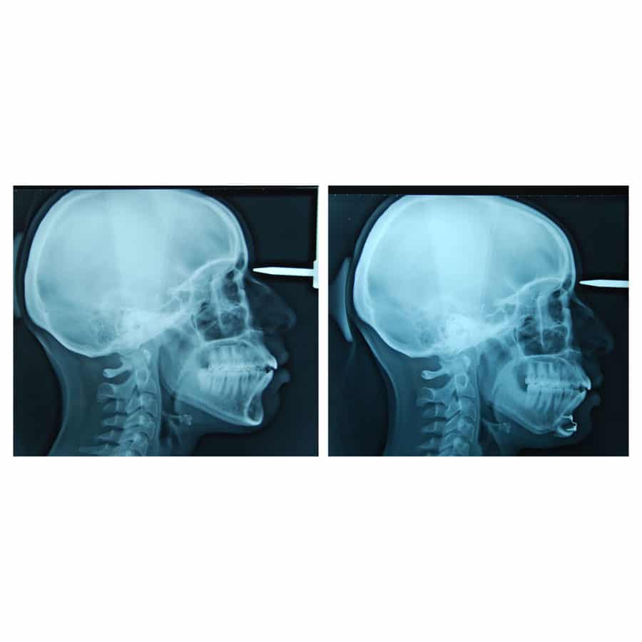 genioplastie reduction hauteur et avancee chirurgien paris menton tele profil radiographie 1