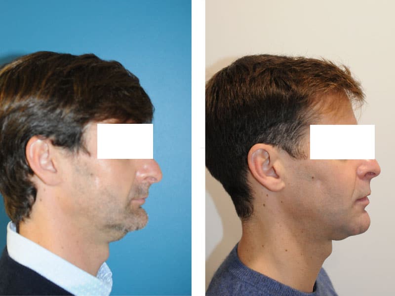 chirurgie maxillo faciale à paris avant après chirurgie des mâchoires retrognathie apnee du sommeil