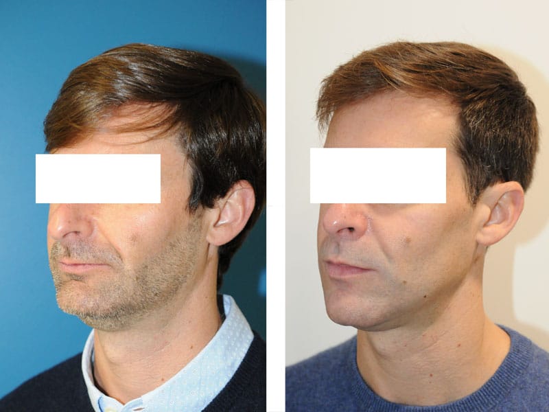 chirurgie maxillo faciale à paris avant après chirurgie des mâchoires retrognathie apnee du sommeil