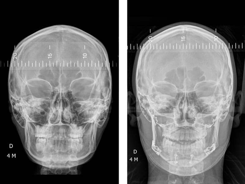 chirurgien maxillo facial paris chirurgie guidée avant après meilleur