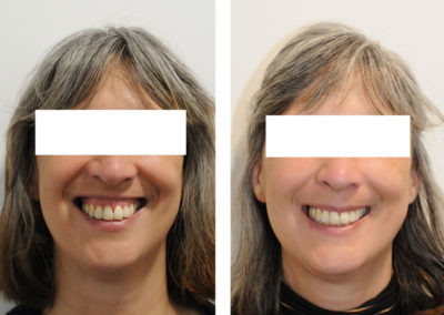 sourire gingival traitement chirurgie paris impaction maxillaire injections botox prix meilleur chirurgie pas cher muscles releveurs 8 avant apres