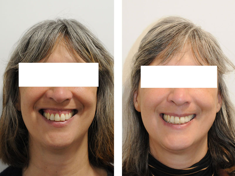 sourire gingival traitement chirurgie paris impaction maxillaire injections botox prix meilleur chirurgie pas cher muscles releveurs 8 avant apres