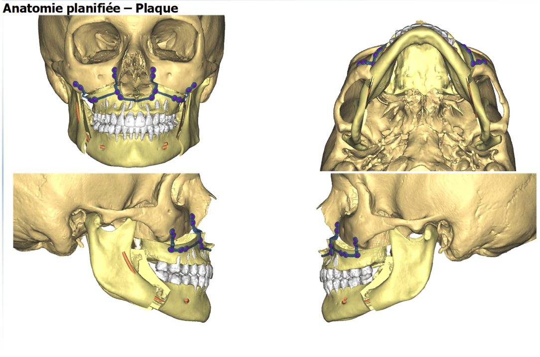 chirurgie maxillo faciale chirurgie guidée chirurgie 3d implants simulation paris 2