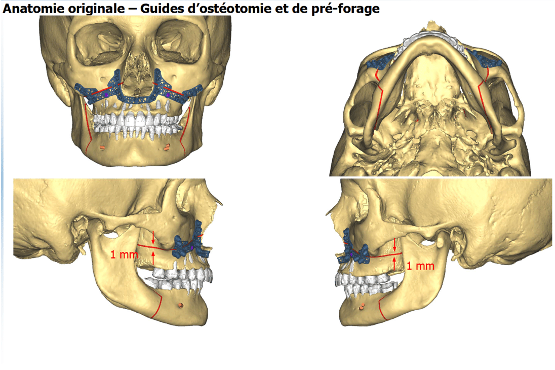 chirurgie maxillo faciale chirurgie guidée chirurgie 3d implants simulation paris