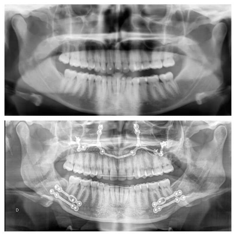 radiographie radio chirurgien maxillo facial paris meilleur cas chirurgie bimaxillaire 2