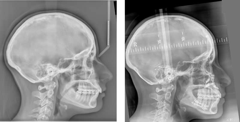 radiographie radio chirurgien maxillo facial paris meilleur cas chirurgie bimaxillaire 3
