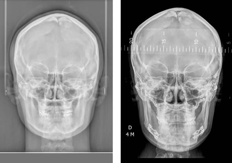 radiographie radio chirurgien maxillo facial paris meilleur cas chirurgie bimaxillaire