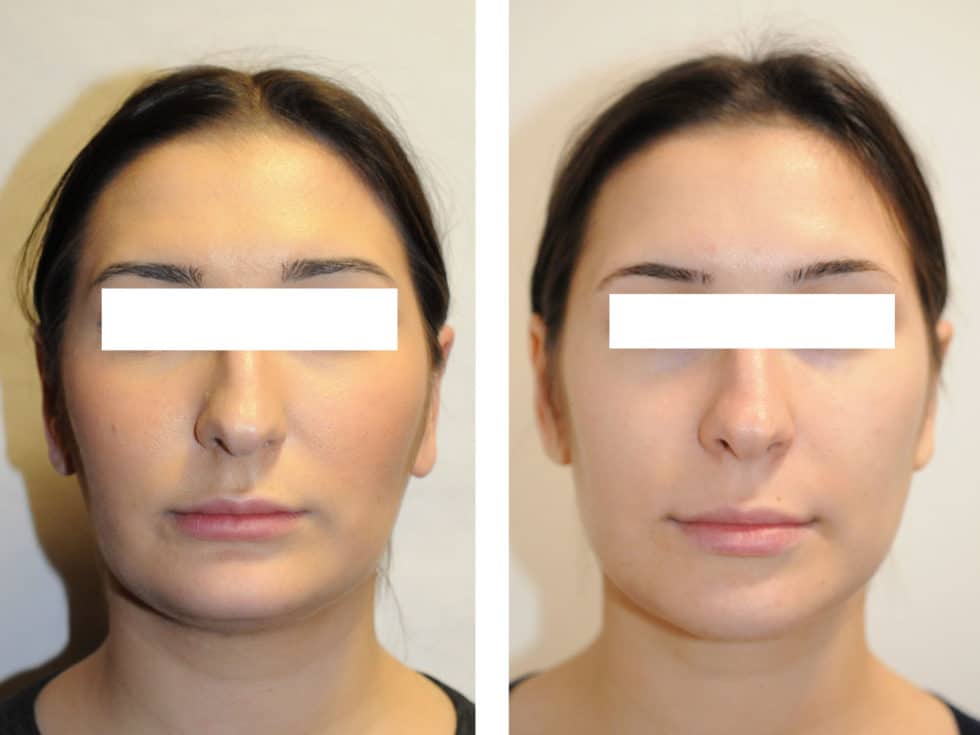 Chirurgie MaxilloFaciale Paris, Chirurgie du Menton Paris Classe II
