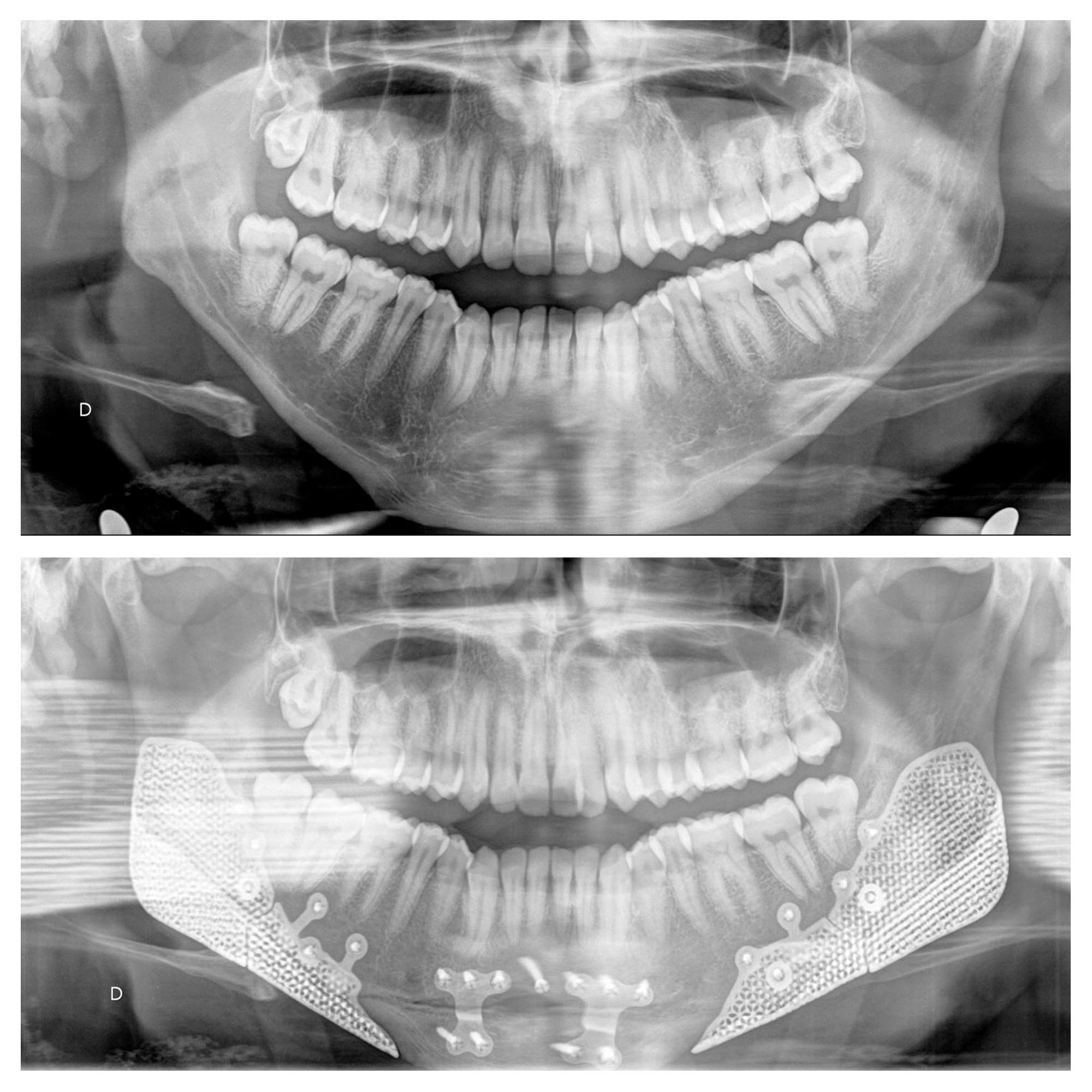 implants mandibulaires angles mandibulaires 3d implant titane sur mesure france paris 8