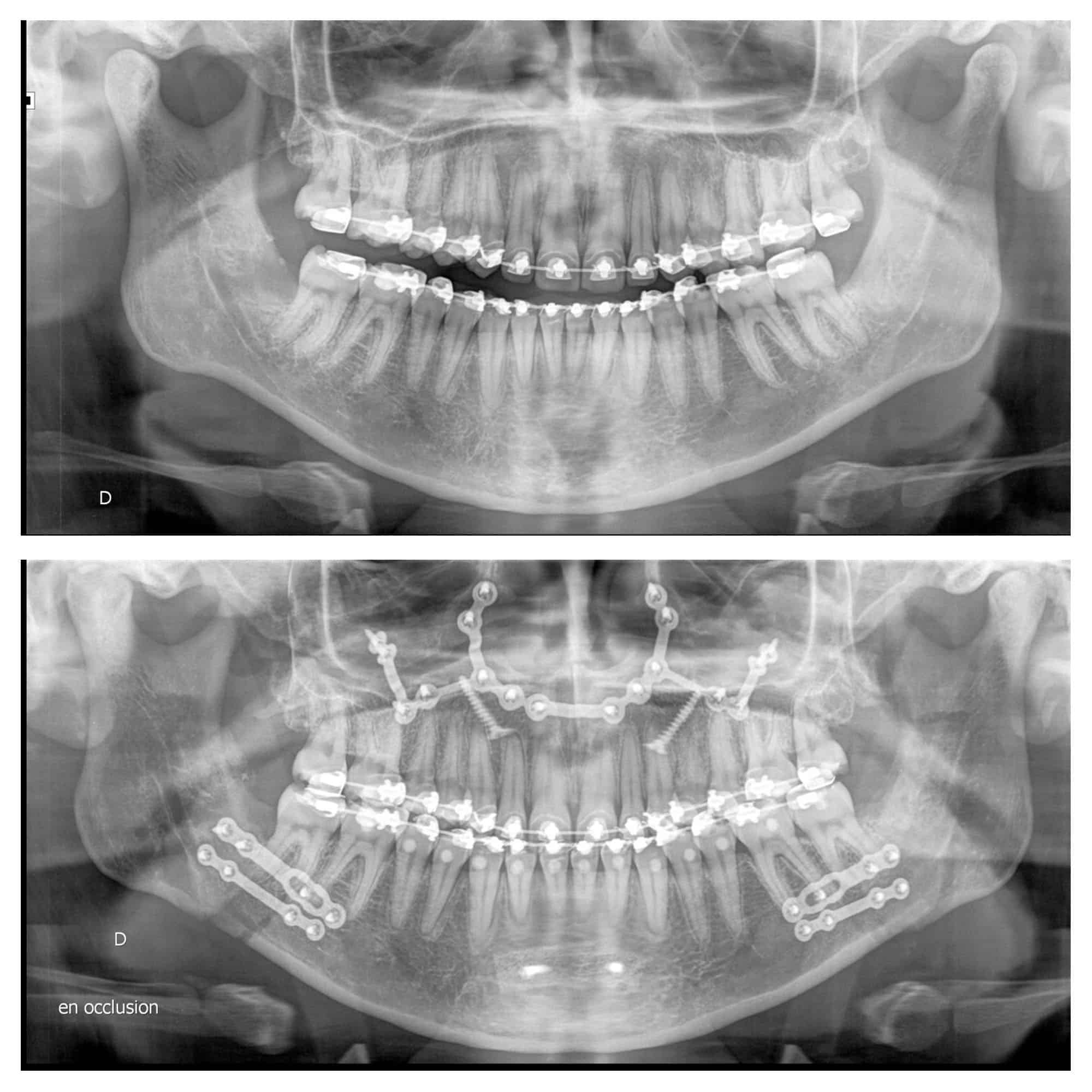 classe II radiographie radio chirurgien maxillo facial paris meilleur cas chirurgie bimaxillaire 7 radiographies avant apres