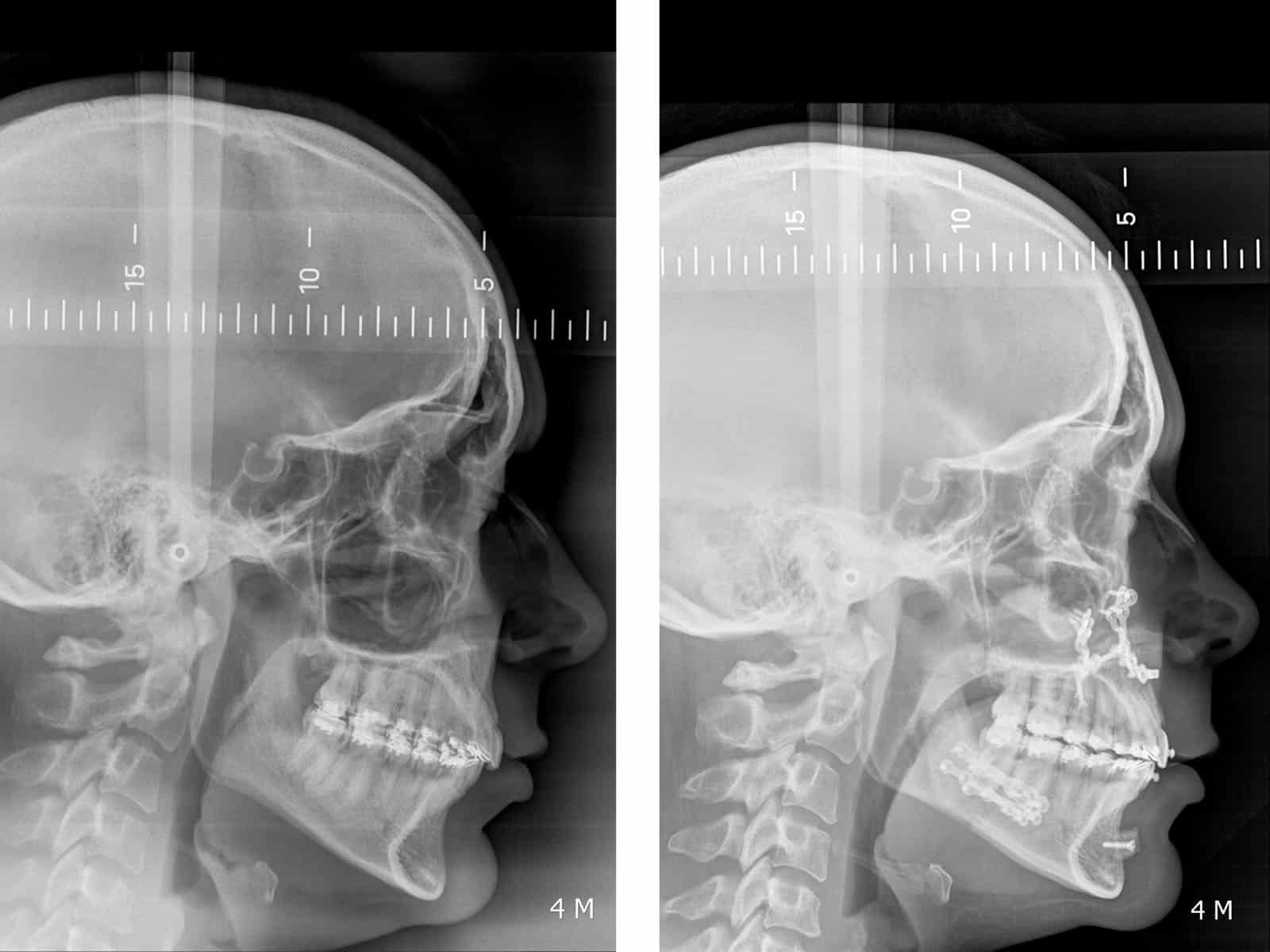 classe II radiographie radio chirurgien maxillo facial paris meilleur cas chirurgie bimaxillaire 7 radiographies profil avant apres