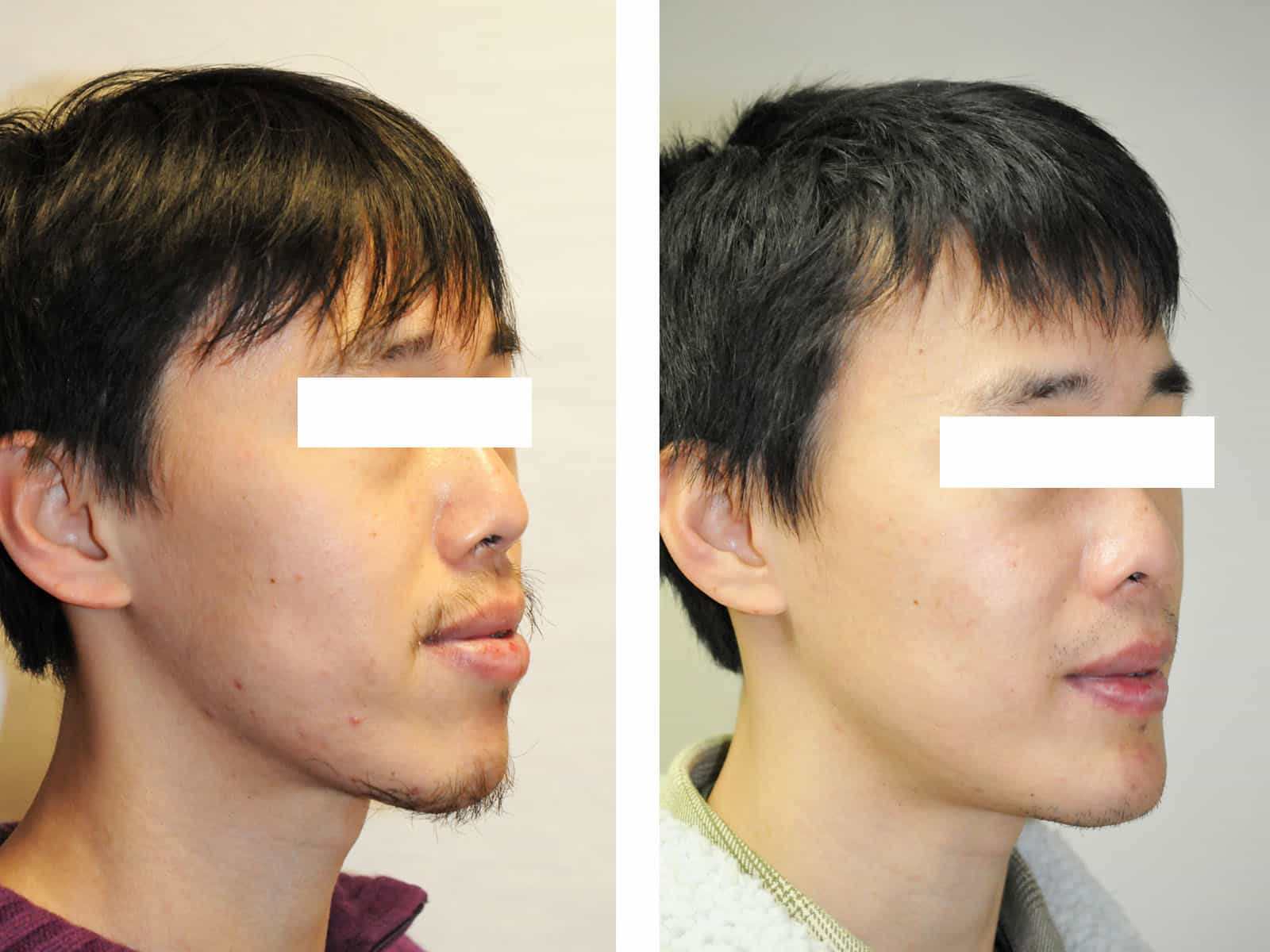 classe III distraction disjonction maxillaire lefort 1 classe III recentrage avant après chirurgie maxillo facial paris génioplastie dr loncle