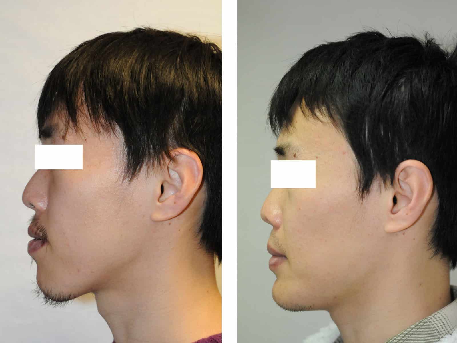 classe III distraction disjonction maxillaire lefort 1 classe III recentrage avant après chirurgie maxillo facial paris génioplastie dr loncle