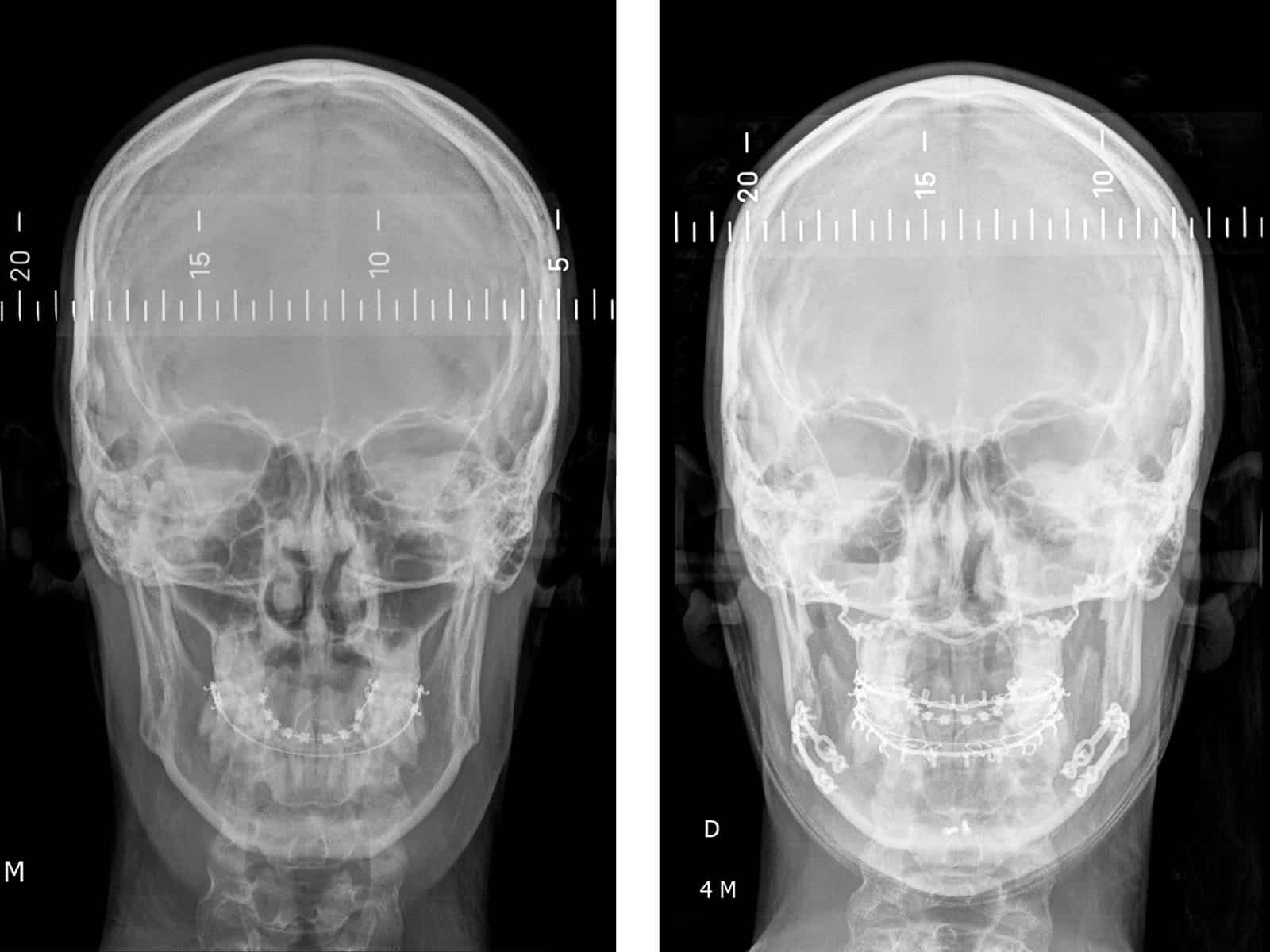 classe II radiographie radio chirurgien maxillo facial paris meilleur cas chirurgie bimaxillaire 7 trois quart flouté