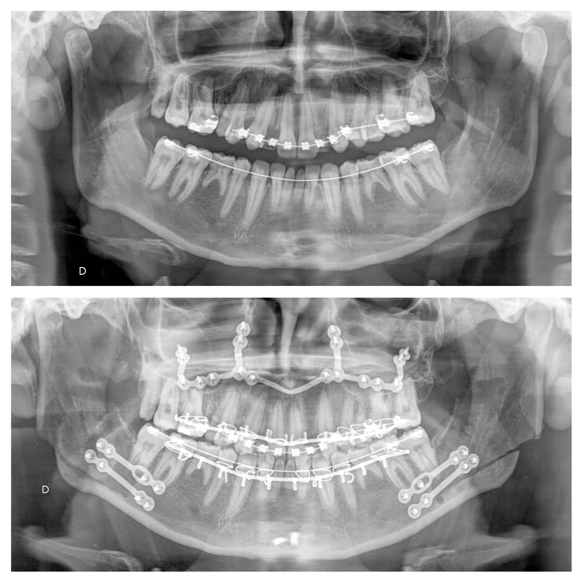 classe II radiographie radio chirurgien maxillo facial paris meilleur cas chirurgie bimaxillaire 7 trois quart flouté