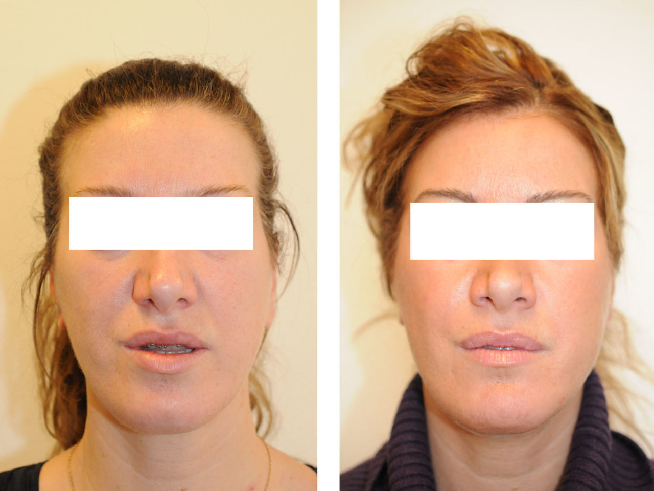 Cas Avant/Après de Chirurgie des Mâchoires à Paris | Classe III