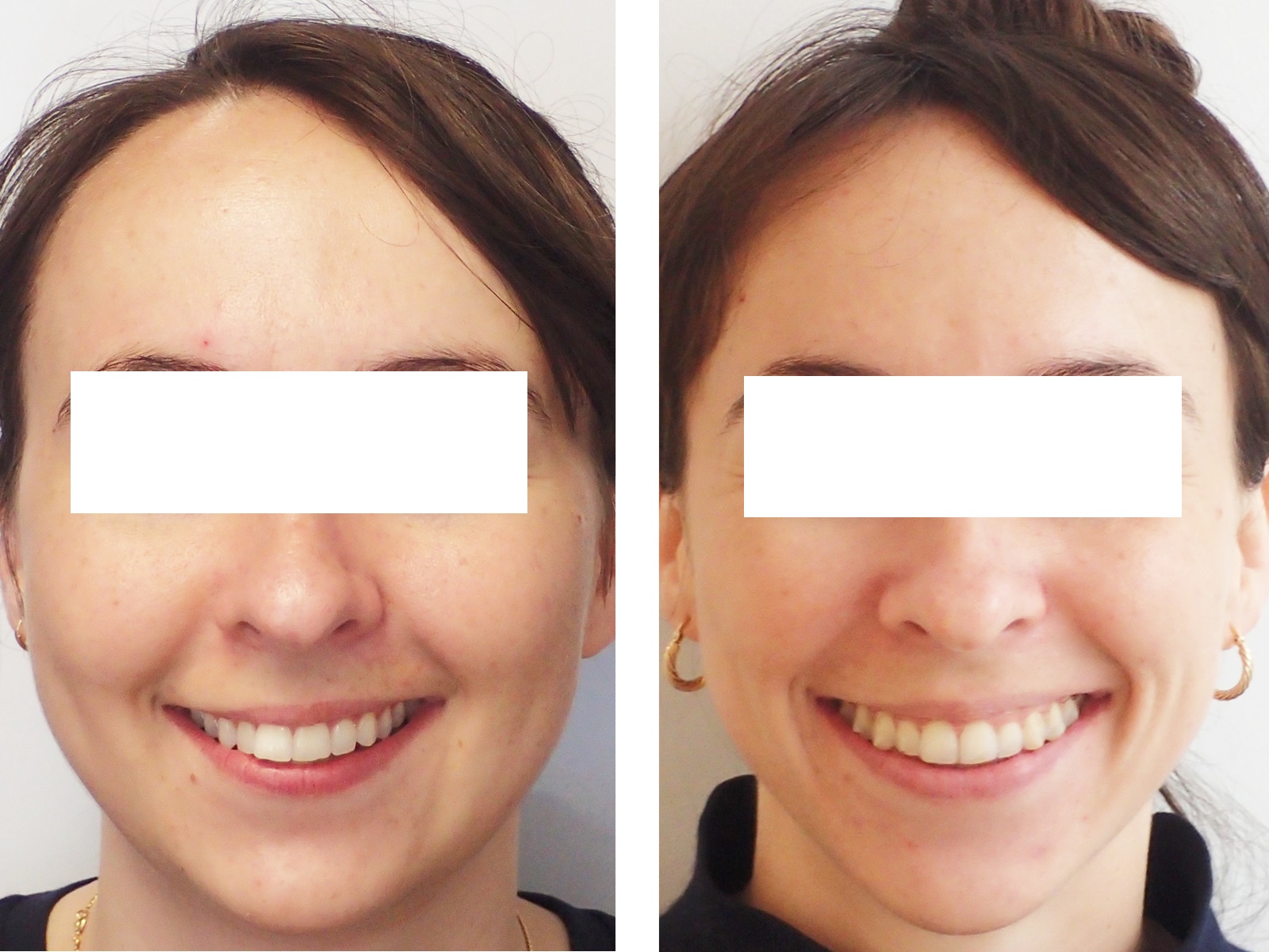 chirurgie maxillo faciale chirurgie apnee du sommeil ronflement classe ii disjonction distration paris 2