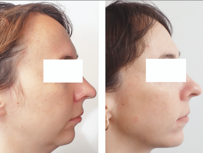 chirurgie maxillo faciale chirurgie apnee du sommeil ronflement classe ii disjonction distration paris 3